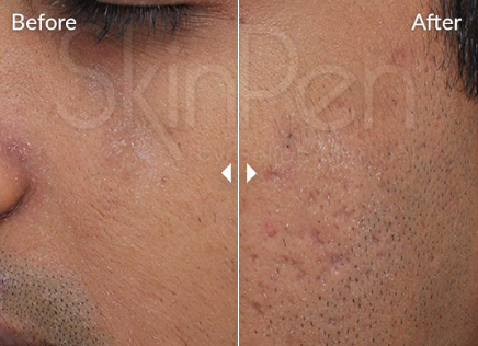 skinpen before and after