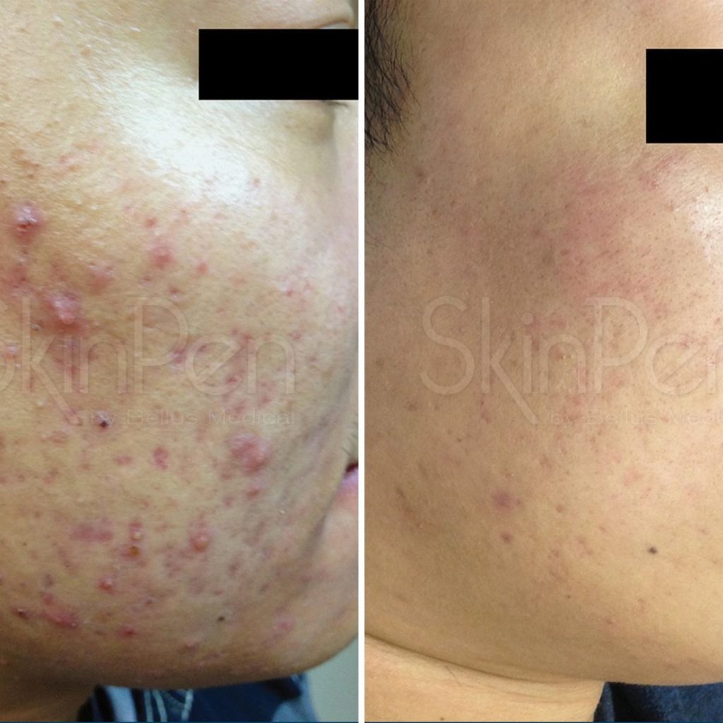 skinpen before and after