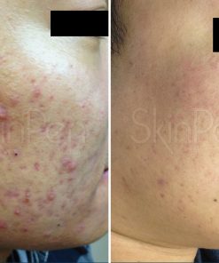 skinpen before and after