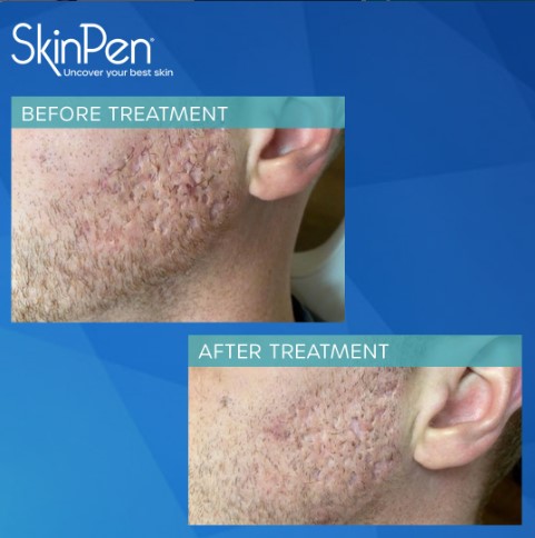 this is a photo of a patients before and after microneedling treatment 