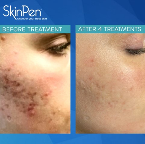 this is a before and after acne scars treatment with microneedling