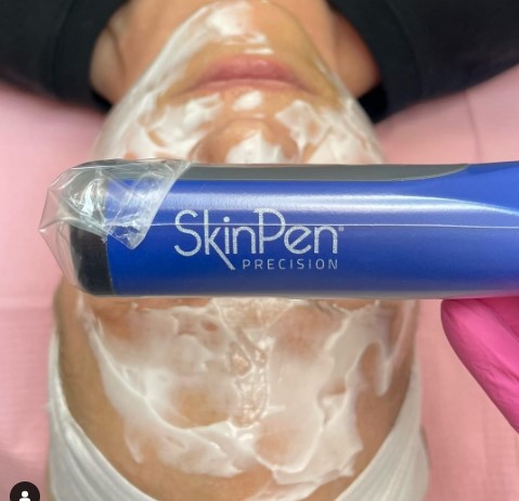 photo of skinpen and a lady how her face was prep before microneedling treatment with skinpen