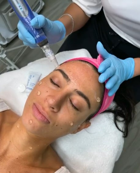 photo of a lady's face prep before  microdeedling treatment