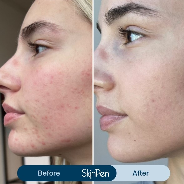 This is a photo of before and after skinpen microneedling treatment results