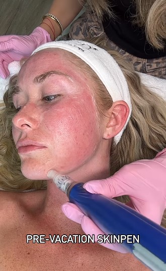 redness after skinpen precision microneedling treatments