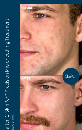 photo of results after 1 skinpen treatment