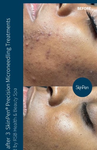 this is a photo of results after 3 skinpen precision microneedling treatments