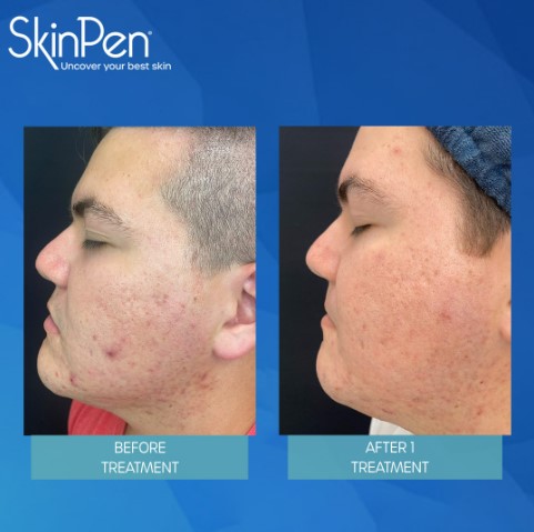 When over-the-counter treatments fail, SkinPen microneedling treatments can help you improve the appearance of facial acne scars 

This patient saw significant improvement after just 1 SkinPen treatment