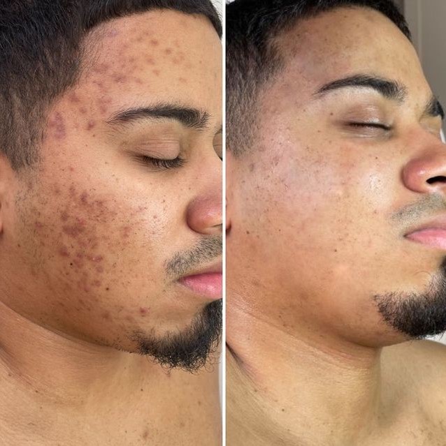 photo of a patient's before and after treatment with skinpen