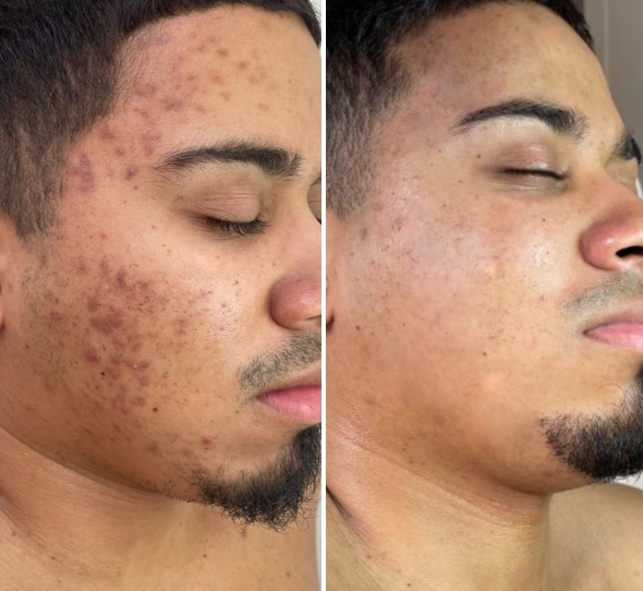 skinpen precision elite